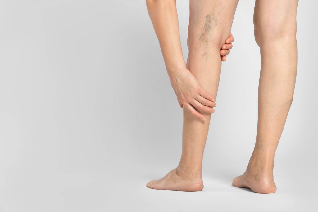 Close-up of varicose veins on a woman's lower leg and calf